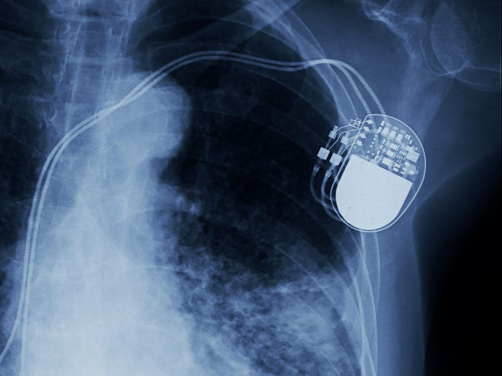 pacemaker-xray-cingulum