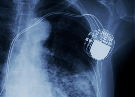 pacemaker-cingulum