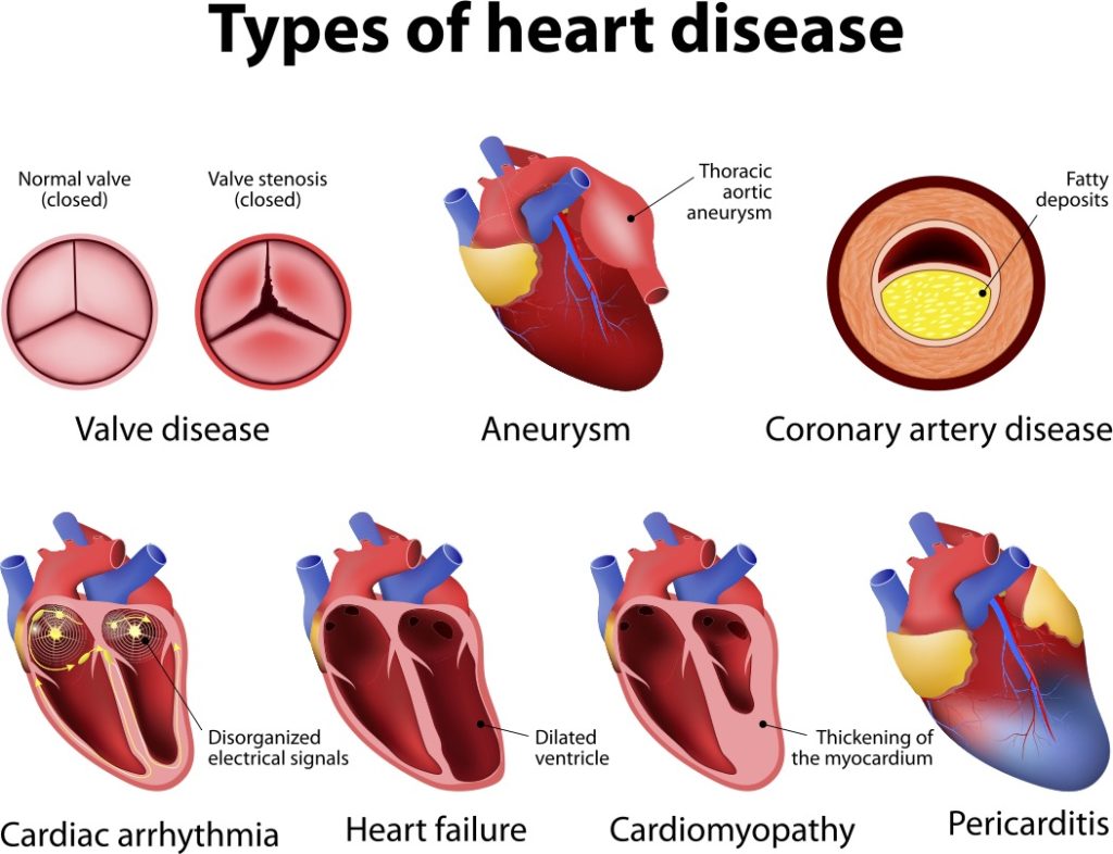 hjertesvikt-hjertesykdommer-cingulum
